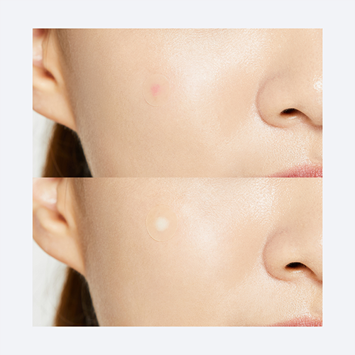 Acne Pimple Master Patch 24 Patches (3 Sizes)